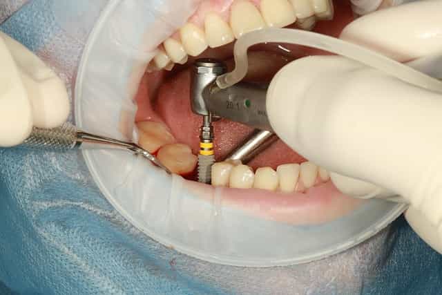 Dental implants in Montrose